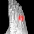 How to Properly Diagnose and Treat a Stress Fracture in Your Foot