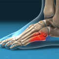 The Truth About Foot Pain: Tendonitis vs Fracture