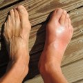 Expert Insights: Understanding Midfoot Arthritis and How to Find Relief