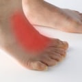 The Healing Process of Tendonitis on Top of the Foot