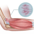 Understanding Tendinitis: Causes, Symptoms, and Treatment