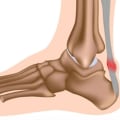 The Truth About Foot Tendonitis: Causes, Treatment, and Recovery