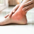 Expert Tips for Treating Inflammation on the Top of Your Foot