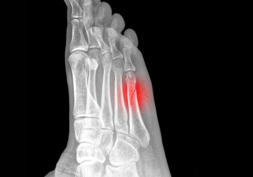 How to Properly Diagnose and Treat a Stress Fracture in Your Foot