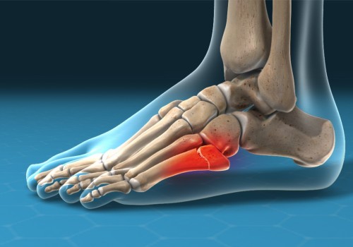 The Misdiagnosis of Foot Pain: Tendonitis or Fracture?