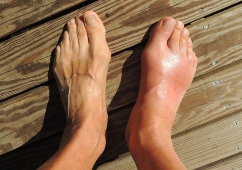 Expert Insights: Understanding Midfoot Arthritis and How to Find Relief