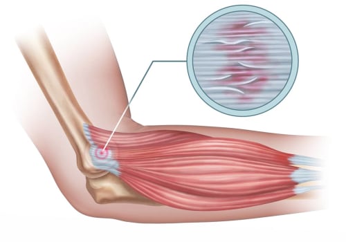 Understanding Tendinitis: Causes, Symptoms, and Treatment