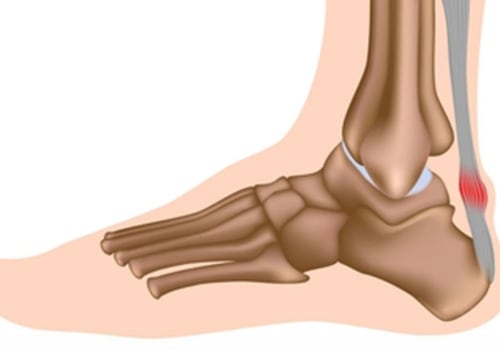 The Truth About Foot Tendonitis: Causes, Treatment, and Recovery