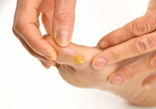 How to Remove Calluses From Feet Permanently Without Harsh Treatments