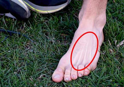 Understanding Stress Fractures in the Foot